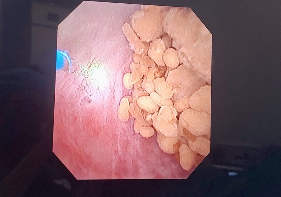 Điều trị bệnh lý dị dạng cổ đài thận bằng công nghệ laser