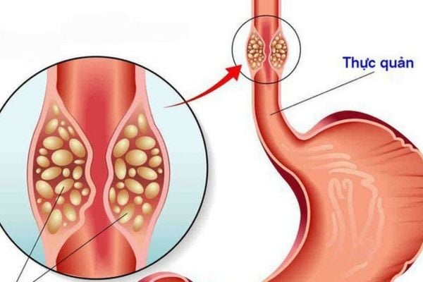 Phẫu thuật nội soi điều trị túi thừa thực quản