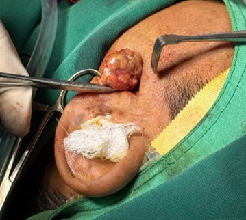 U tuyến nước bọt mang tai: đừng chủ quan với khối sưng không đau”